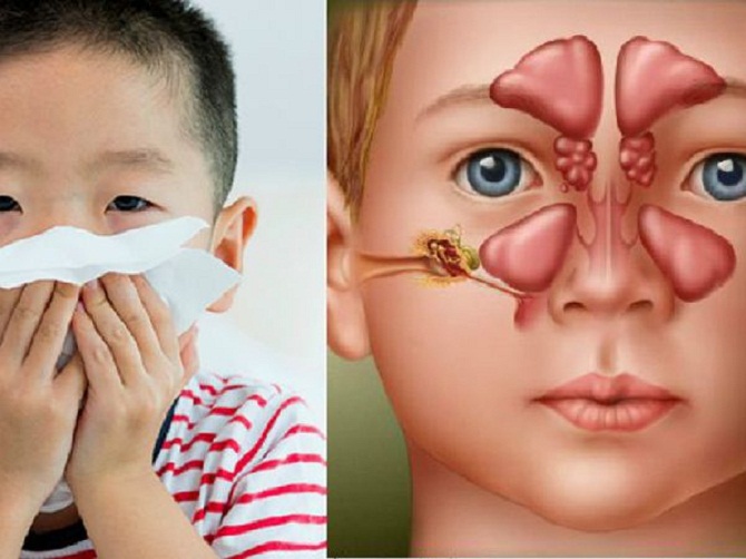 Một số câu hỏi thường gặp liên quan đến bệnh chảy nước mũi ở trẻ nhỏ